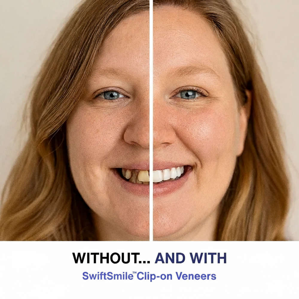 SwiftSmile™ Clip-on Veneers – Dentix Labs